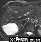 肝脏疾病典型影像学表现 肝脏疾病典型影像学表现