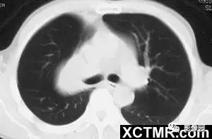 【病例】右肺上叶中央型肺癌1例CT影像表现