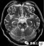 【病例】脑桥中央髓鞘溶解症1例MR影像表现分析