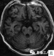 【病例】脑桥中央髓鞘溶解症1例MR影像表现分析