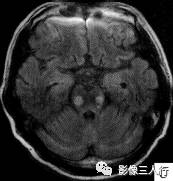 【病例】脑桥中央髓鞘溶解症1例MR影像表现分析