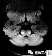 【病例】脑桥中央髓鞘溶解症1例MR影像表现分析