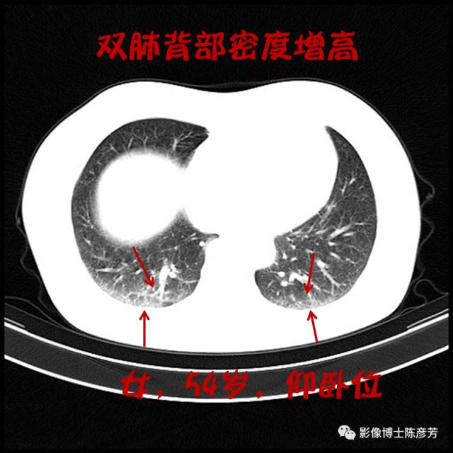二手烟的肺竟然是这样的