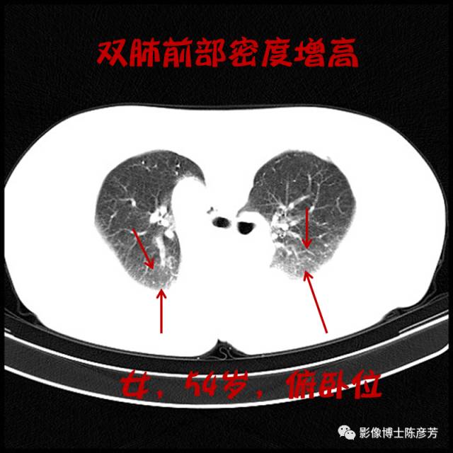 二手烟的肺竟然是这样的