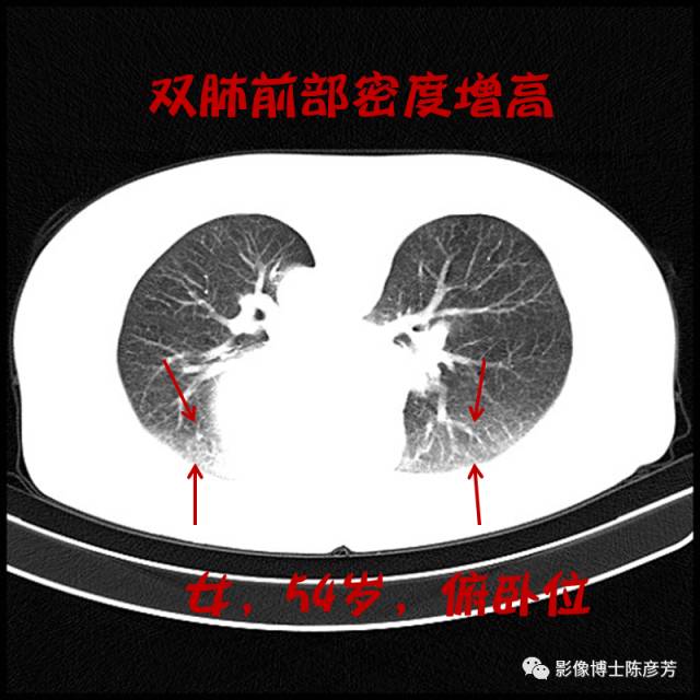 二手烟的肺竟然是这样的