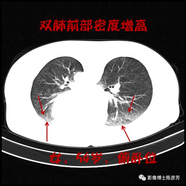 二手烟的肺竟然是这样的