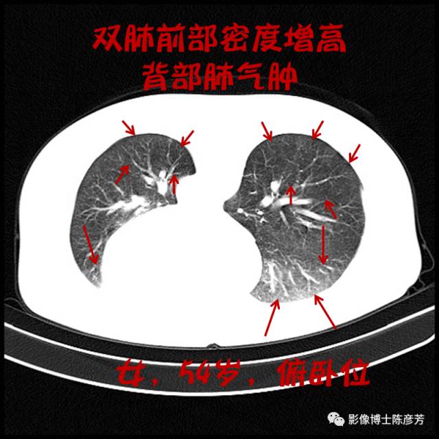 二手烟的肺竟然是这样的