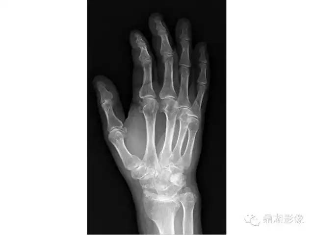 【病例】软骨钙盐沉着症1例X线影像表现