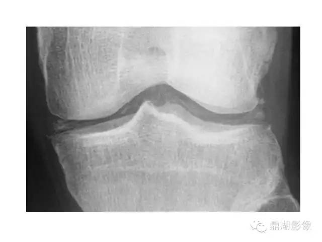 【病例】软骨钙盐沉着症1例X线影像表现