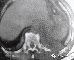 “裸区征” 的影像表现与临床意义