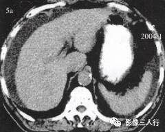 “裸区征” 的影像表现与临床意义