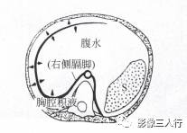 “裸区征” 的影像表现与临床意义