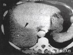 “裸区征” 的影像表现与临床意义