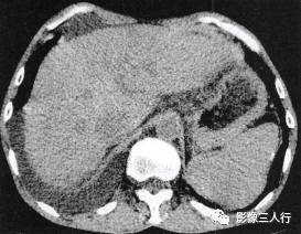 “裸区征” 的影像表现与临床意义