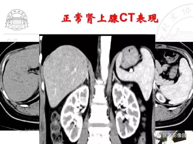 【PPT】肾上腺占位性疾病的影像学诊断