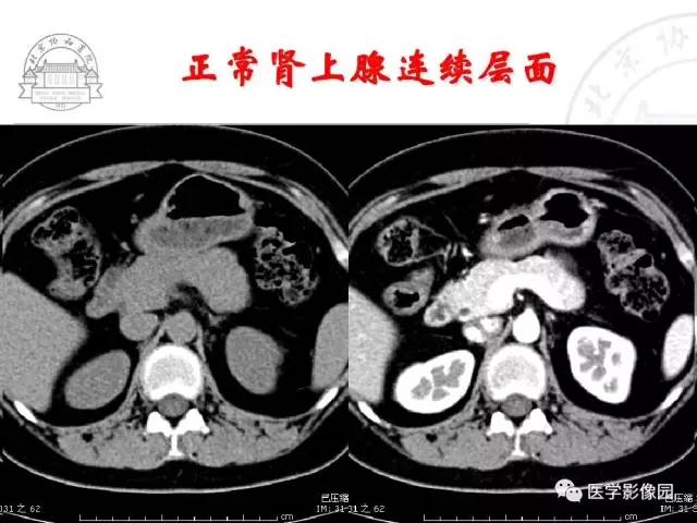 【PPT】肾上腺占位性疾病的影像学诊断