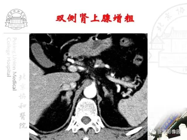 【PPT】肾上腺占位性疾病的影像学诊断