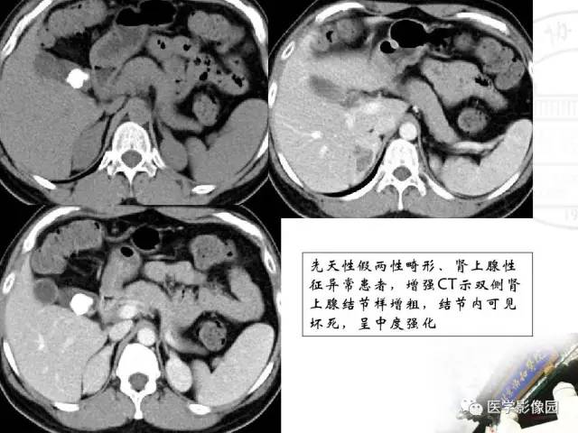 【PPT】肾上腺占位性疾病的影像学诊断