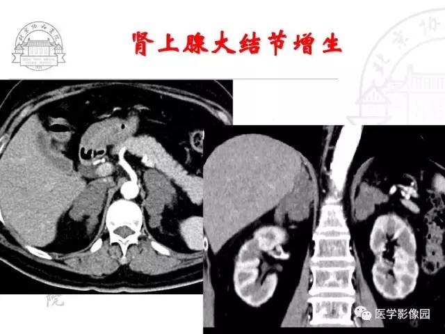 【PPT】肾上腺占位性疾病的影像学诊断
