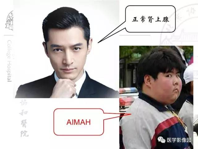 【PPT】肾上腺占位性疾病的影像学诊断