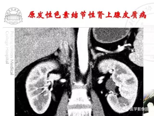 【PPT】肾上腺占位性疾病的影像学诊断