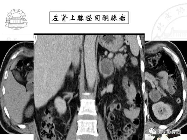 【PPT】肾上腺占位性疾病的影像学诊断