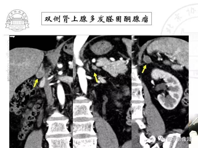 【PPT】肾上腺占位性疾病的影像学诊断