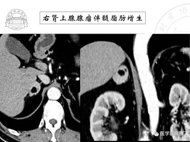 【PPT】肾上腺占位性疾病的影像学诊断