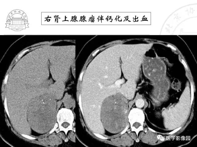 【PPT】肾上腺占位性疾病的影像学诊断