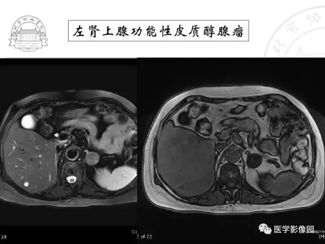 【PPT】肾上腺占位性疾病的影像学诊断