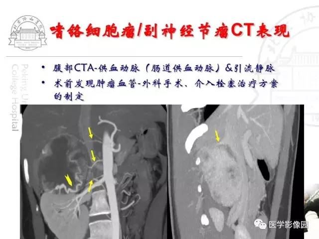 【PPT】肾上腺占位性疾病的影像学诊断