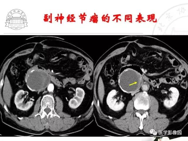 【PPT】肾上腺占位性疾病的影像学诊断