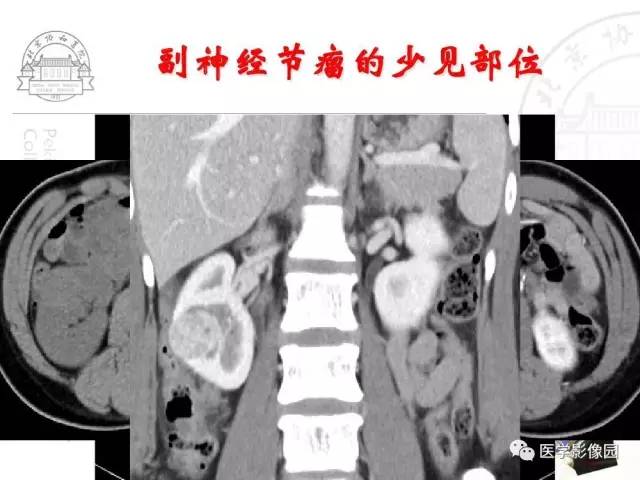 【PPT】肾上腺占位性疾病的影像学诊断