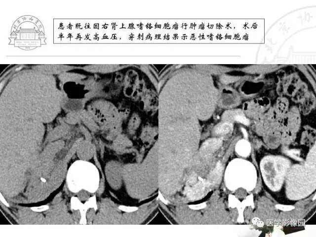 【PPT】肾上腺占位性疾病的影像学诊断