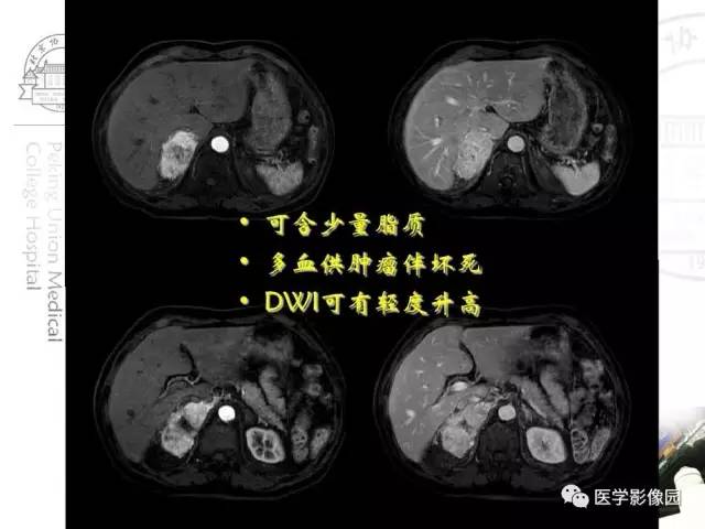 【PPT】肾上腺占位性疾病的影像学诊断