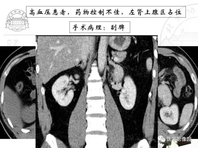 【PPT】肾上腺占位性疾病的影像学诊断
