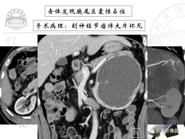 【PPT】肾上腺占位性疾病的影像学诊断