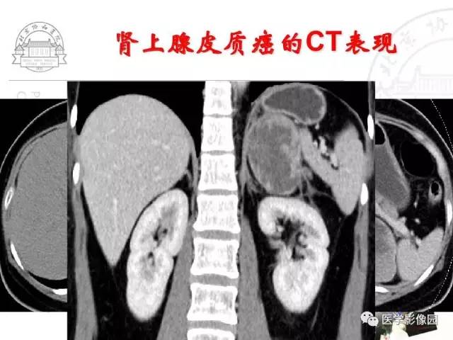 【PPT】肾上腺占位性疾病的影像学诊断