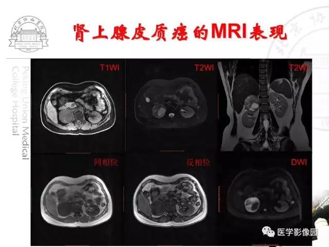 【PPT】肾上腺占位性疾病的影像学诊断