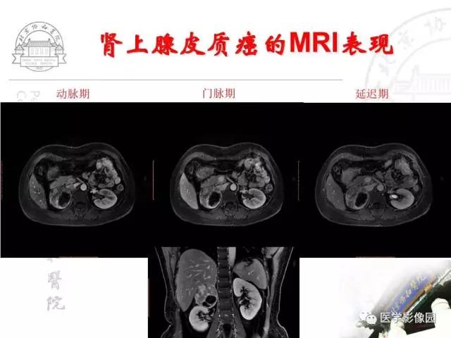 【PPT】肾上腺占位性疾病的影像学诊断