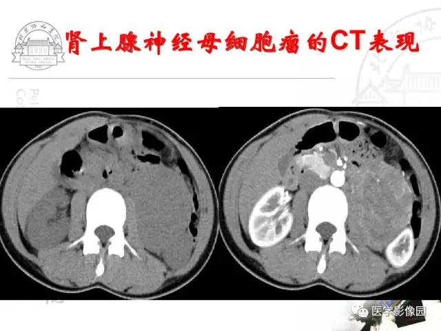 【PPT】肾上腺占位性疾病的影像学诊断
