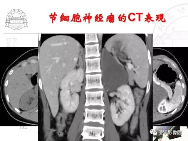 【PPT】肾上腺占位性疾病的影像学诊断