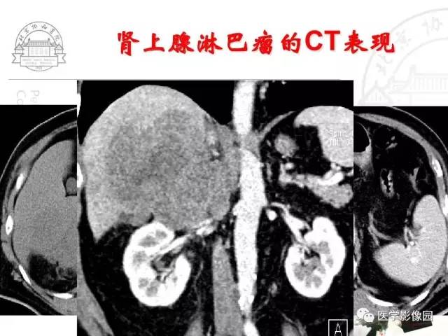 【PPT】肾上腺占位性疾病的影像学诊断