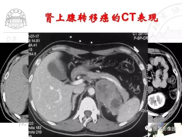 【PPT】肾上腺占位性疾病的影像学诊断