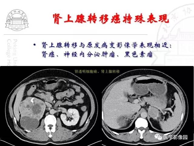 【PPT】肾上腺占位性疾病的影像学诊断
