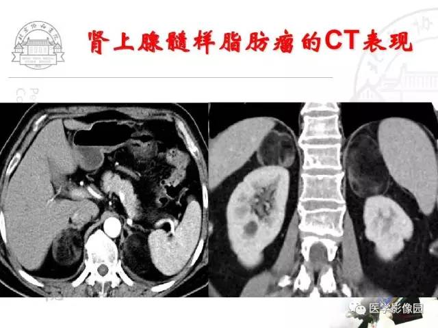 【PPT】肾上腺占位性疾病的影像学诊断