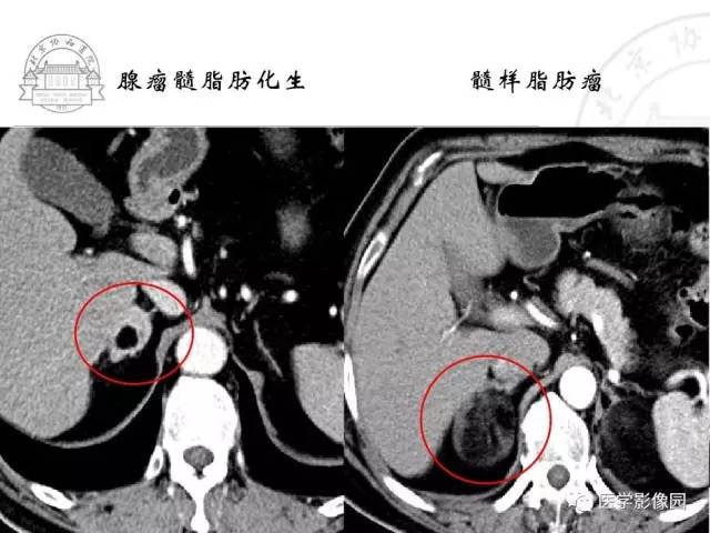 【PPT】肾上腺占位性疾病的影像学诊断
