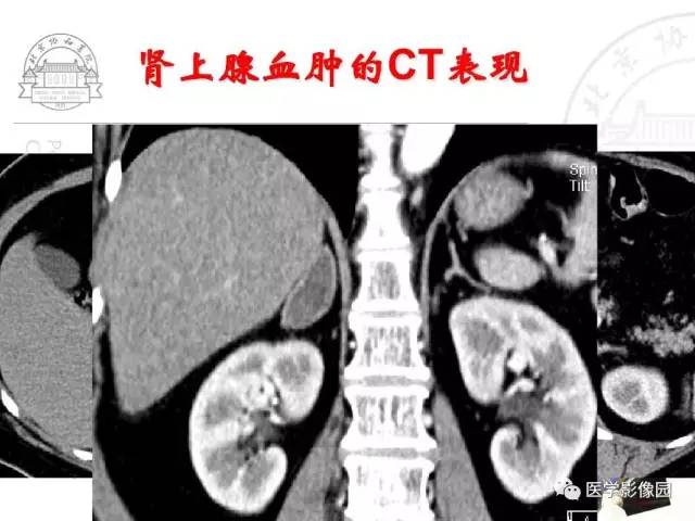 【PPT】肾上腺占位性疾病的影像学诊断