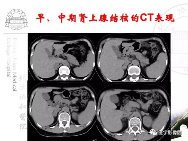 【PPT】肾上腺占位性疾病的影像学诊断