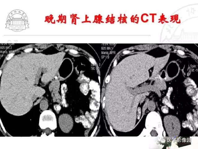 【PPT】肾上腺占位性疾病的影像学诊断